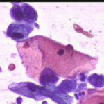 Παραβασικά κύτταρα με διογκωμένους ομοιογενείς, χωρίς ορατή δομή χρωματίνης πυρήνες. Επίχρισμα του 2003